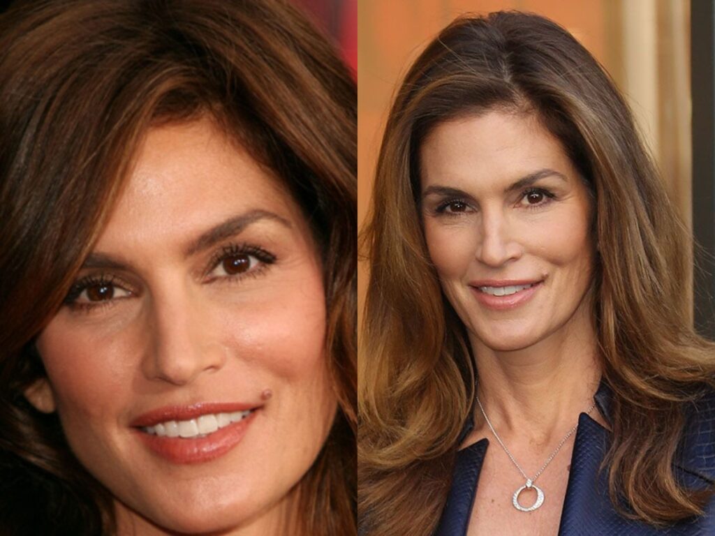 Cindy Crawford Plastic Surgery - With Before And After Photos