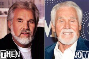 kenny rogers facelift