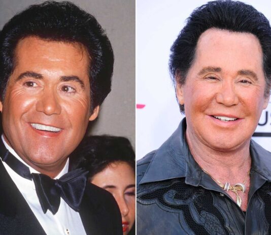 Wayne Newton Plastic Surgery – With Before And After Photos
