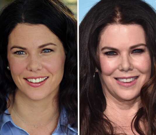 Lauren Graham Plastic Surgery – With Before And After Photos