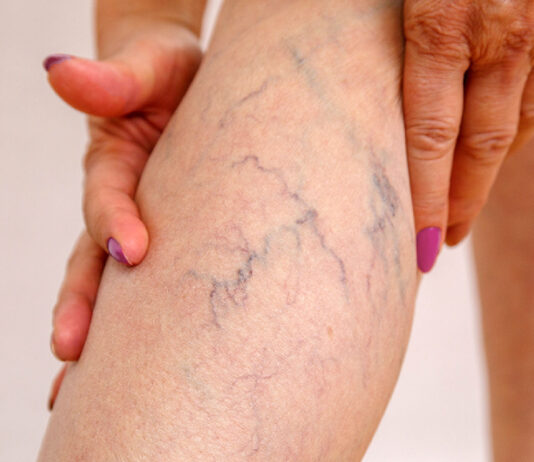 How To Know if You Are an Ideal Candidate for Sclerotherapy