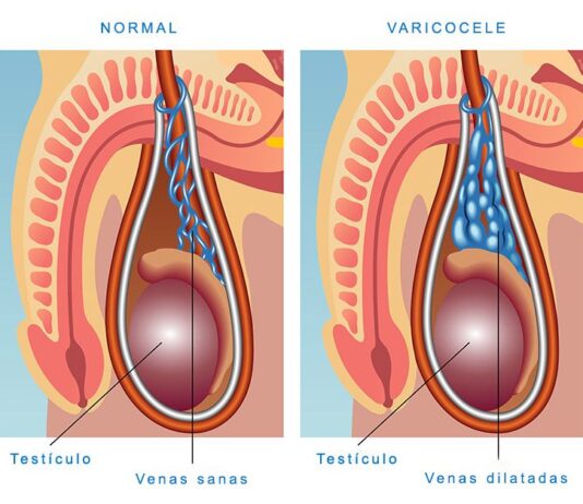 Everything You Need to Know About Varicocele Embolization